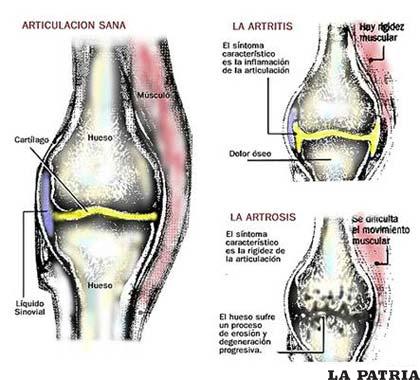 En la gráfica una descripción del estado normal de las articulaciones y las degeneraciones provocadas por la artritis y la artrosis