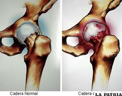 La artrosis es una enfermedad degenerativa que afecta las articulaciones