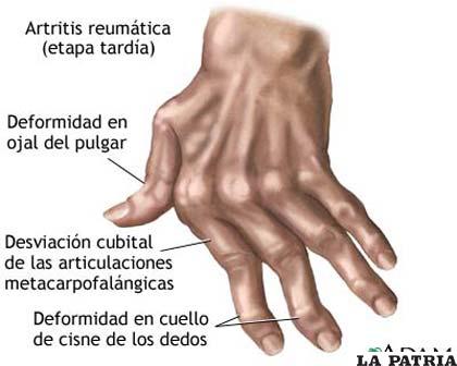 La artritis reumatoidea es un tipo de reumatismo destructivo y afecta más a las mujeres
