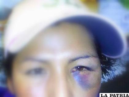 El ojo morado de una de las mujeres agredidas, evidencia la violencia intrafamiliar