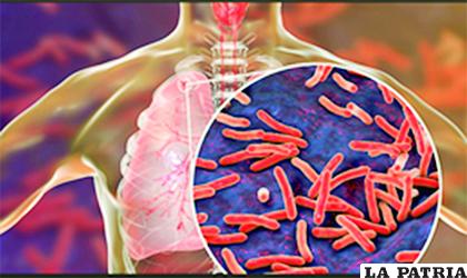 Tuberculosis pulmonar, infección por Mycobacterium tuberculosis