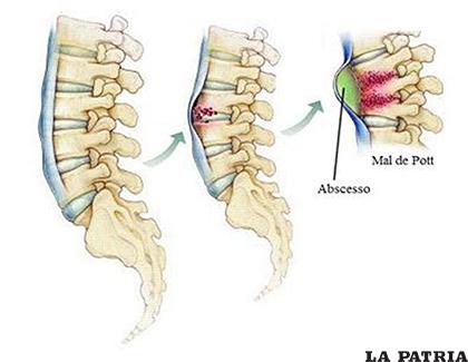 Proceso de evolución de la enfermedad a partir de una discitis (inflamación del disco verterbral) hasta compromiso de los cuerpos vertebrales y formación del absceso (colección de pus) paravertebral