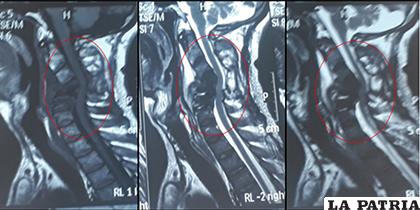 Resonancia Magnética muestra destrucción vertebral en cervical 4, 5 y 6 con compromiso medular. Imagen propia