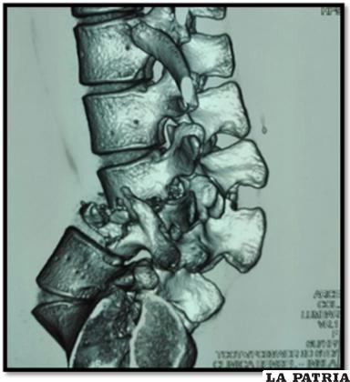Destrucción de cuerpo vertebral de lumbar 4. Imagen propia