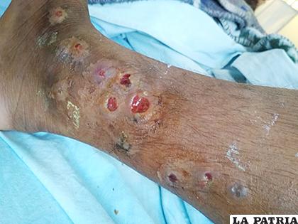 Heridas en el paciente son en distintos lugares de la piel /LA PATRIA /ARCHIVO