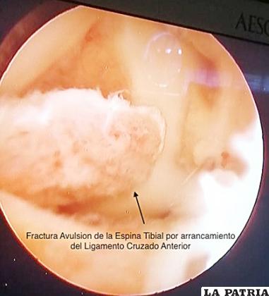 Imagen del procedimiento quirúrgico /LA PATRIA 
