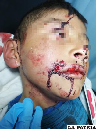 Niño sufrió heridas punzantes en el rostro y recibió 16 puntadas /Sedes