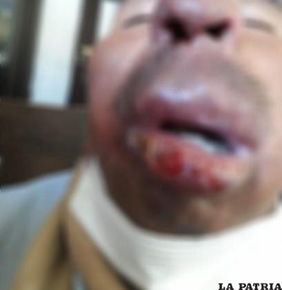 Paciente con Leishmaniasis mucocutánea /SEDES
