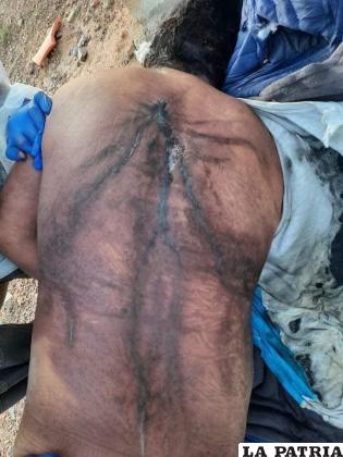 La espalda de la víctima tras ser alcanzado por un rayo /RRSS