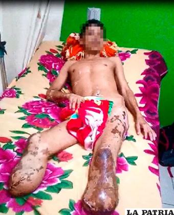 El hombre perdió las dos piernas mientras estaba en la cárcel a pesar de ser inocente /Infobae