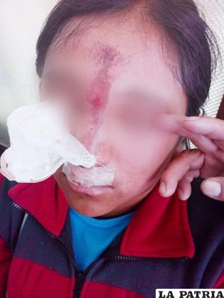 Víctima de canes sufrió heridas en la cara /LA PATRIA