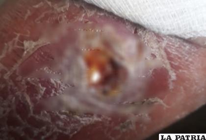 Picadura de mosquito en uno de los pacientes /Sedes