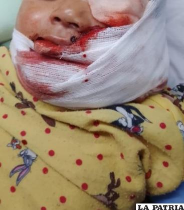 Niña fue ataca por su propio perro en la cara /SEDES

