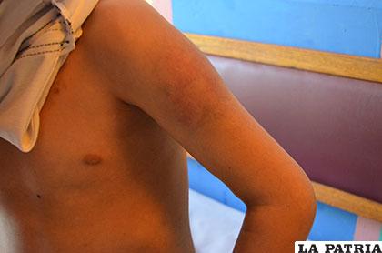 El brazo del niño de 10 años presenta moretones que evidencian la violencia intrafamiliar