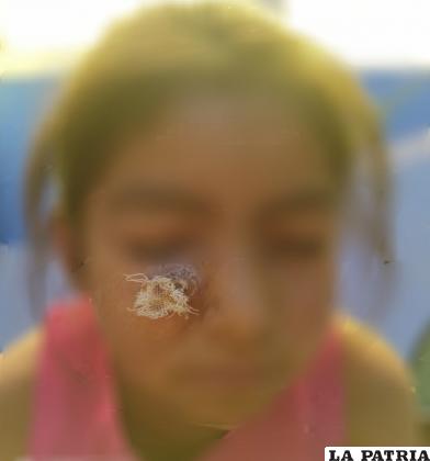 Niña de 5 años fue picada por el mosquito hace un mes en Beni /Sedes