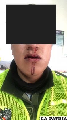 El efectivo policial tiene lesiones en su tabique  
/Cortesía