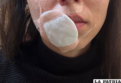 La víctima fue mordida en su labio por su concubino /LA PATRIA