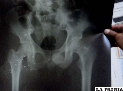 La radiografía muestra que existen esquirlas de bala en la humanidad de uno de los heridos