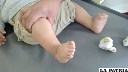 Niño con malformación de extremidades inferiores