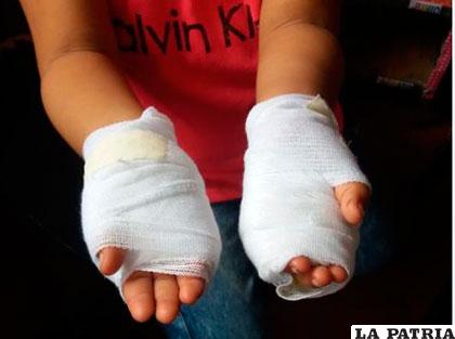 Las manos vendadas de la menor agredida por su padre