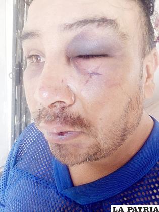 La víctima presenta varios golpes en el rostro / LA PATRIA