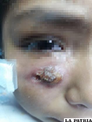 Niña fue picada en el pómulo derecho /Sedes