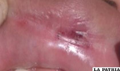 Una de las heridas provocadas en el labio inferior /Cortesía