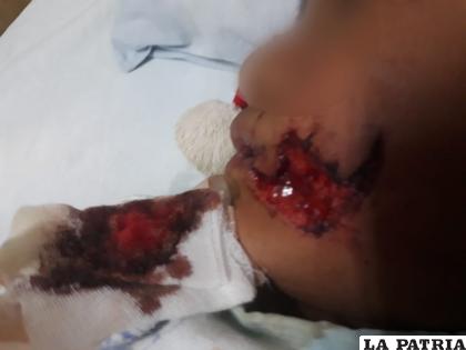 Niña de seis años fue atacada por un perro en el rostro  /Sedes