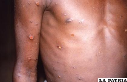 Para evitar contagios se debe aislar a los enfermos de viruela símica /Reuters