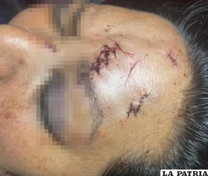  La víctima fue suturada debido a las lesiones graves en su rostro /CORTESÍA
