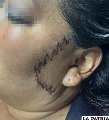 Las esquirlas le provocaron heridas dentro de la oreja /CORTESÍA
