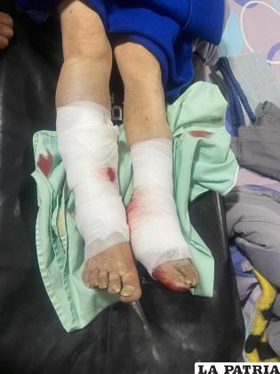 La mujer sufrió daños en ambas piernas / Tránsito