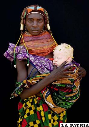 En algunos lugares se usa a los albinos para rituales de brujería