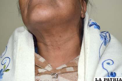 La víctima muestra el cuello que fue sujetado con una cuerda