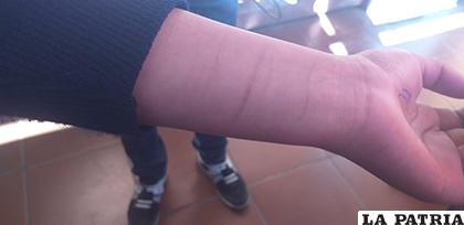 El brazo lastimado de una de las estudiantes /LA PATRIA