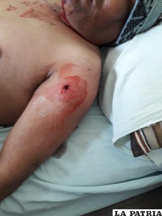 La herida de bala en el sector del hombro izquierdo de la víctima /LA PATRIA
