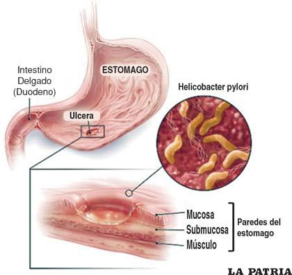 La bacteria helicobacter pylori causa el cáncer de estómago (Foto ingresosmasterred.blogspot.com)