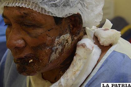 Rostro lacerado de la víctima producto de los golpes y el fuego