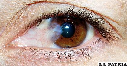 Las cataratas son nubosidades en el cristalino del ojo que dificultan la visión /atusaludenlinea.com
