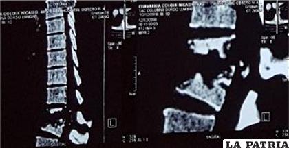 La imagen muestra destrucción de la lumbar 1 y lumbar 2 asociado a notable inestabilidad de columna vertebral