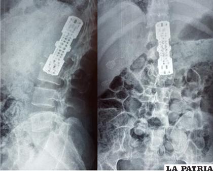Destrucción vertebral por tuberculosis a nivel de la 4ta vértebra lumbar