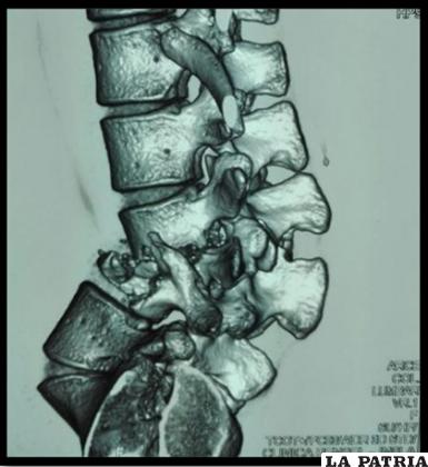 Destrucción de cuerpo vertebral de lumbar 4