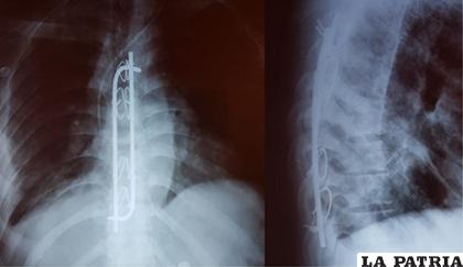 Paciente de muy escasos recursos con dificultad en la adquisición de prótesis de reemplazo de cuerpo vertebral, fue sometido a fijación de columna vertebral con la técnica de Luque modificado. Buenos resultados, evolución favorable