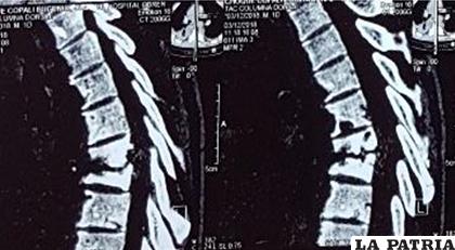 La tomografía muestra destrucción vertebral de dorsal 7 y dorsal 8, asociado a una mayor cifosis dorsal causa de la enfermedad