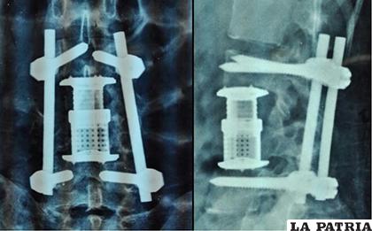 La paciente fue sometida a cirugía, donde se le reemplazó el cuerpo vertebral dañado y se le realizó fijación transpedicular, lo que le restituyó la estabilidad de su columna vertebral