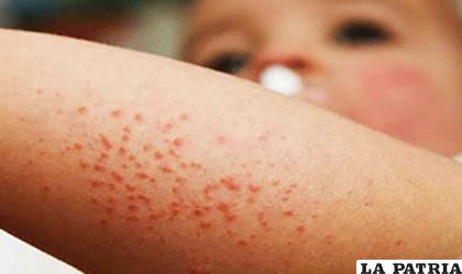 El sarampión presenta granos menudos en la piel del enfermo /LA PATRIA