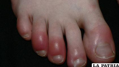 Los pies también son los principales afectados con este mal /trucosnaturales.com