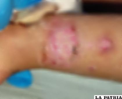 Suben a 8 los casos de leishmaniasis /SEDES