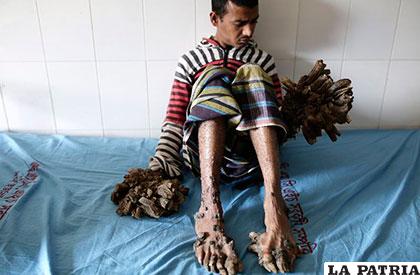 Abul Bajandar, de 27 años, tiene esta extraña enfermedad 