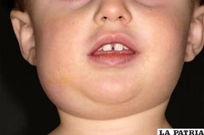 La parotiditis inflama las glándulas salivales en los pacientes /Imagen ilustrativa